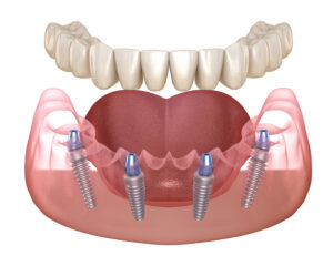 All-on-4 implants