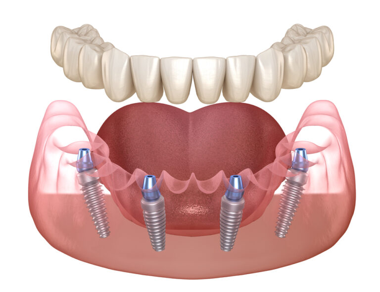 All-on-4 implants